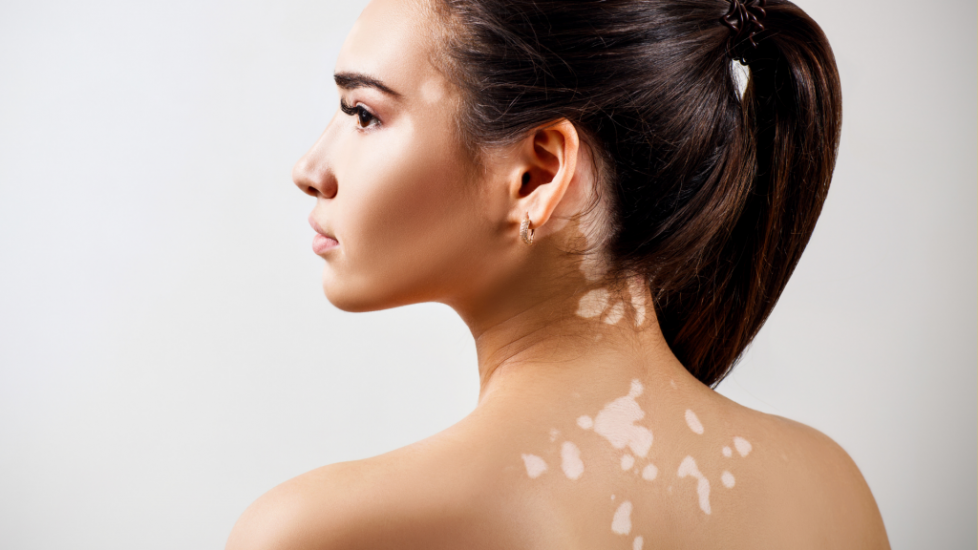 Hatékonyan elfedhető a vitiligo